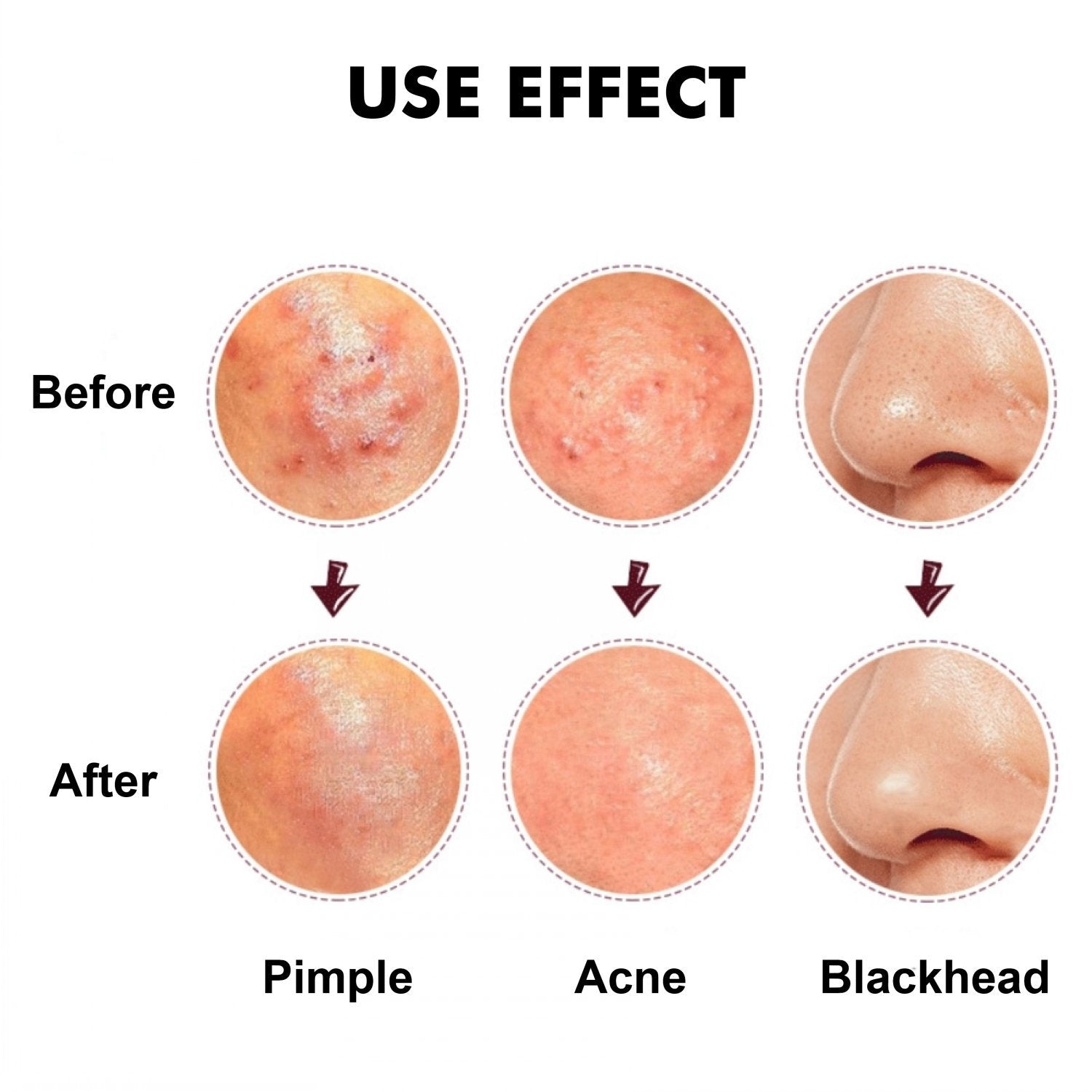 Professional Stainless Steel Blackhead Remover